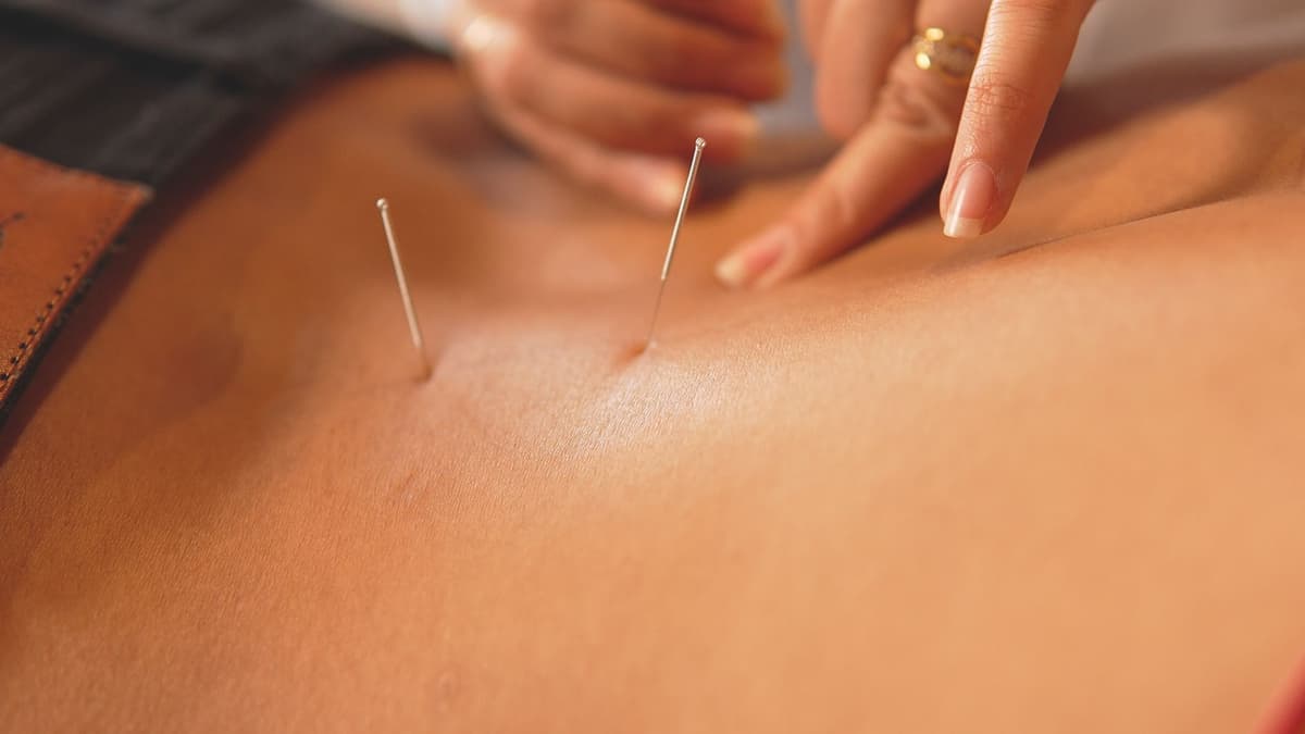 Needle Acupuncture
