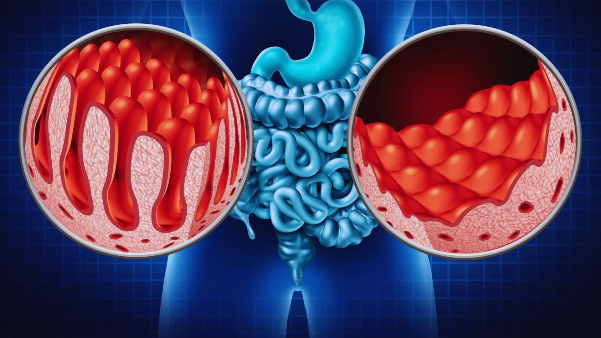 Celiac Disease