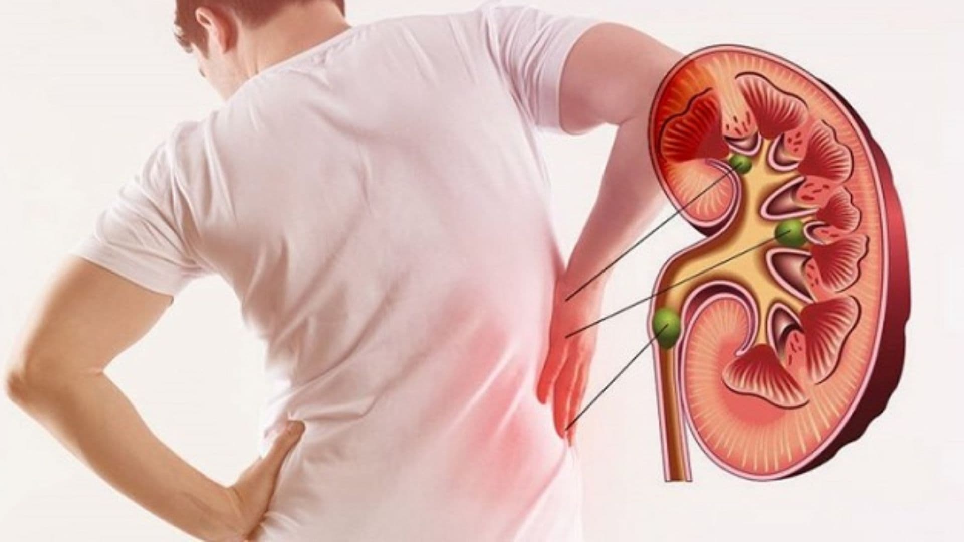 Renal stones