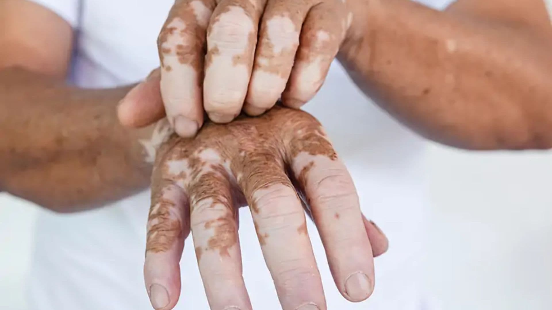 Vitiligo