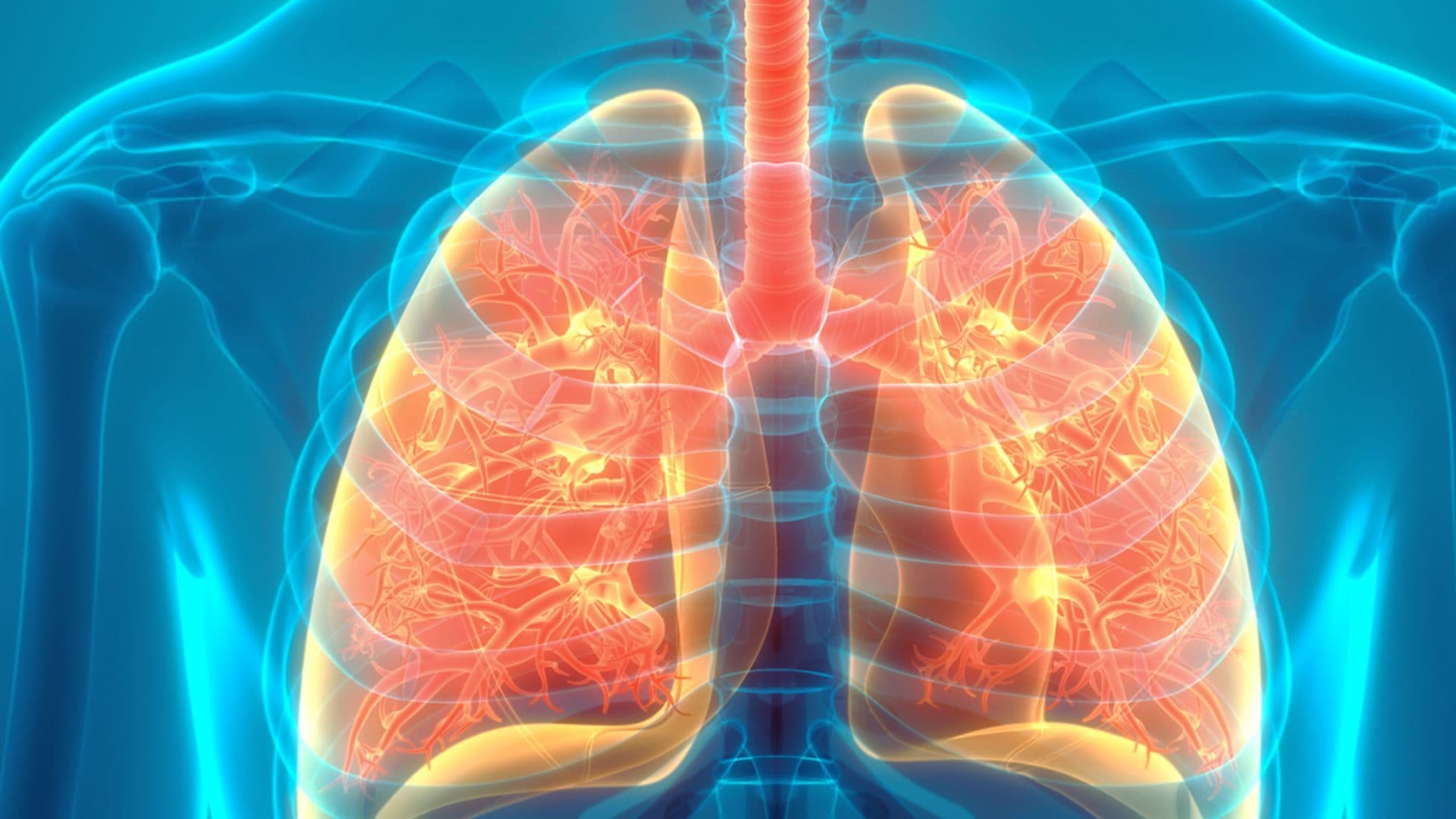 Bronchitis