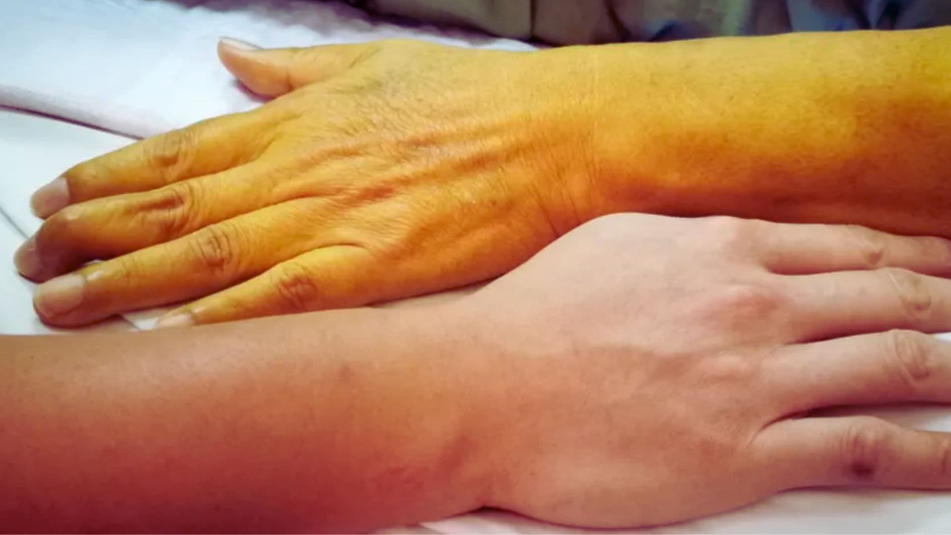 Jaundice