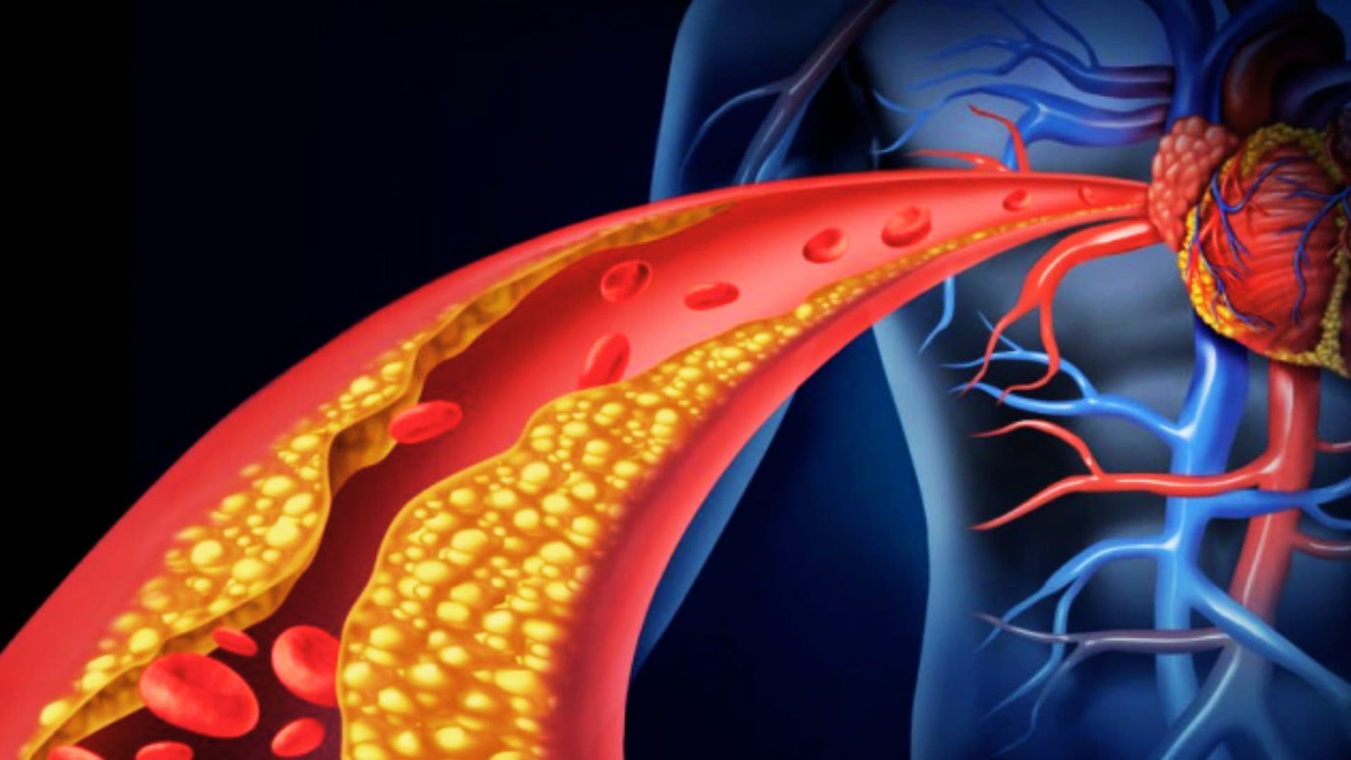 Dyslipidemia