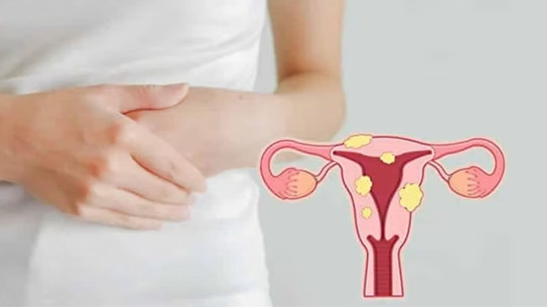 Uterine Fibroids